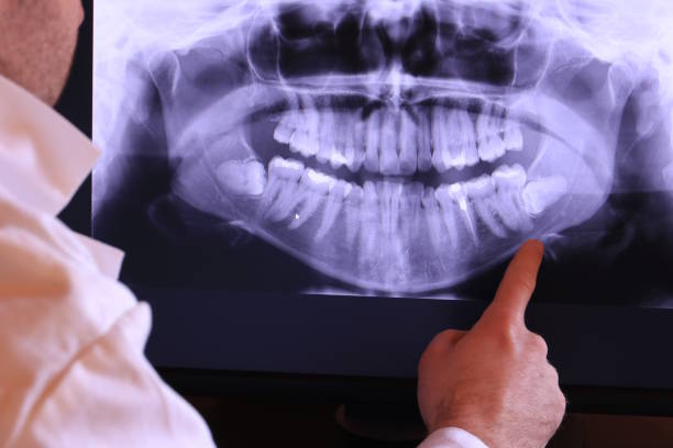 Best Emergency Tooth Extraction in Kinsley, KS